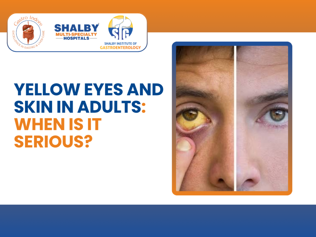 Yellow eyes and skin in adults showing signs of jaundice that may indicate liver disease or bile duct problems requiring medical evaluation.
